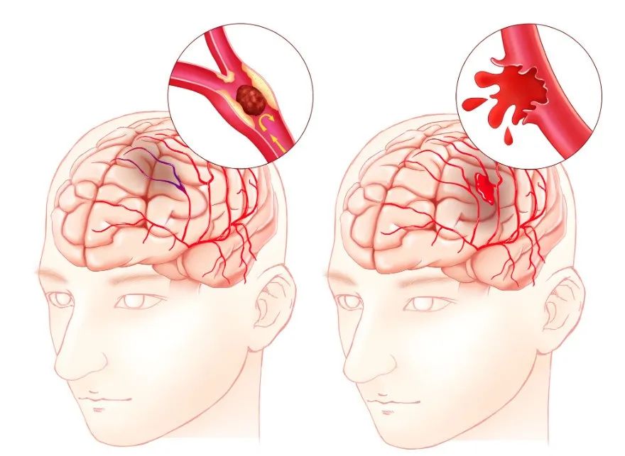 干細胞治療缺血性腦卒中的臨床試驗