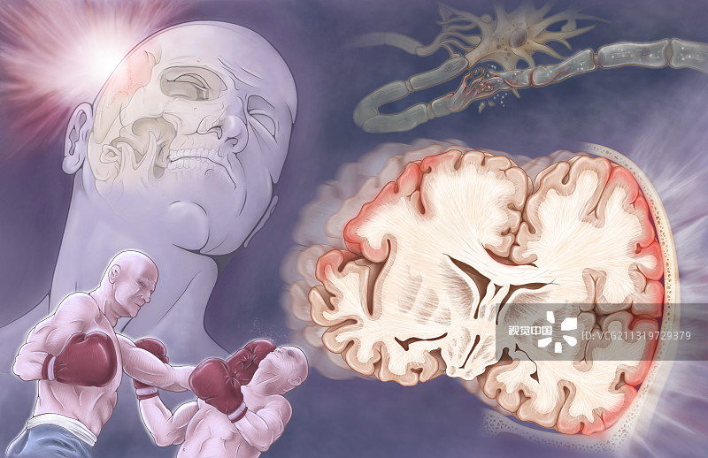 間充質干細胞治療創傷性腦損傷的臨床進展 間充質干細胞治療創傷性腦損傷的臨床進展