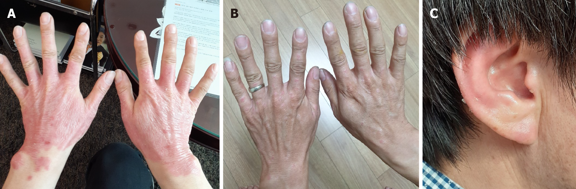 圖3:患者在治療期間和治療后病變部位的可見變化。