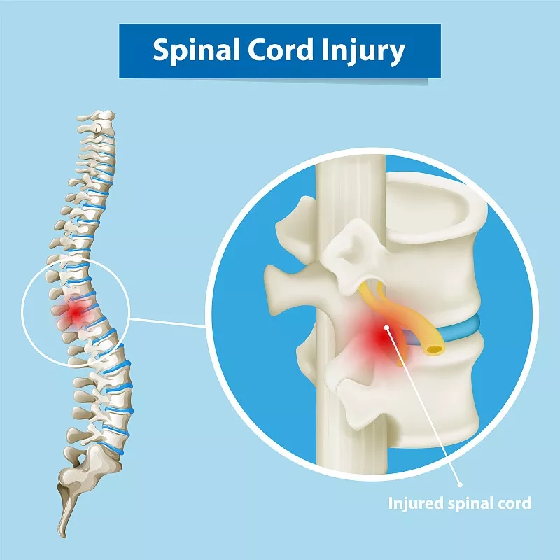 神經(jīng)干/祖細(xì)胞移植治療慢性脊髓損傷的臨床研究進(jìn)展