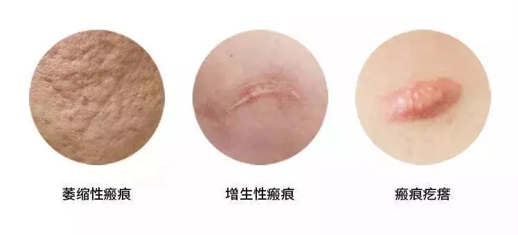 根據瘢痕的顏色、質地和形態，臨床可以將瘢痕分為三大類：萎縮性瘢痕、增生性瘢痕和瘢痕疙瘩。