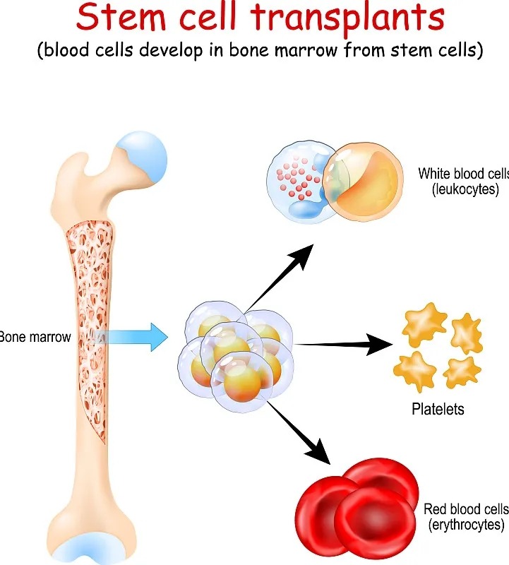 干細胞移植手術 干細胞移植手術