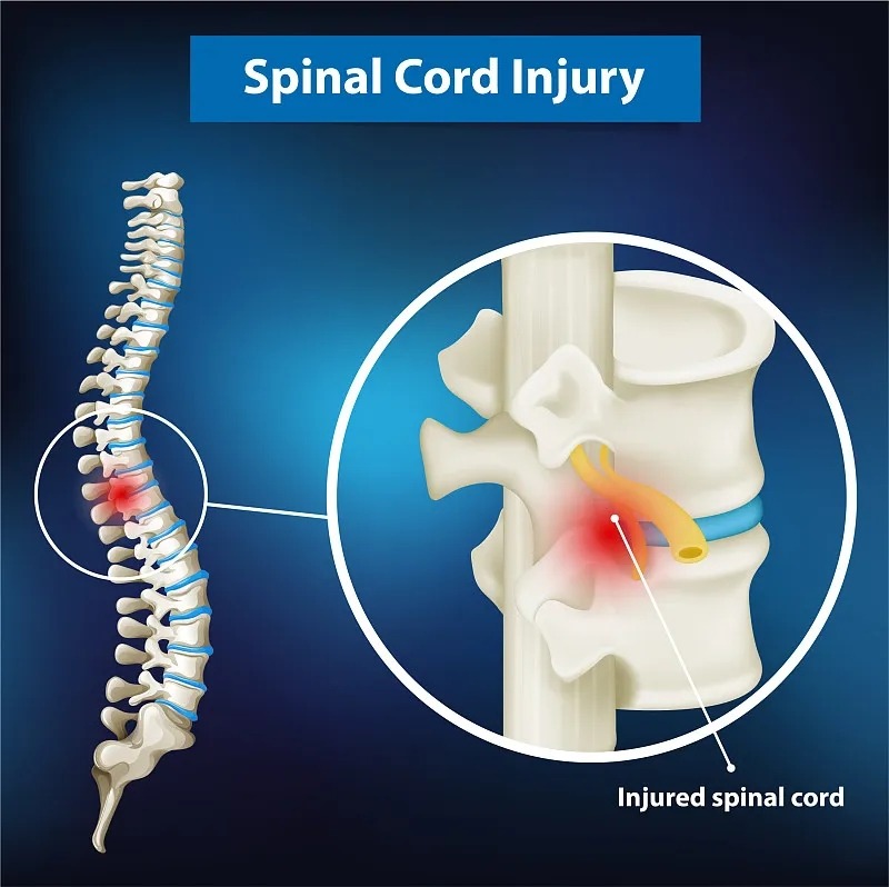 國(guó)家神經(jīng)疾病研究所:脊髓損傷的詳細(xì)信息