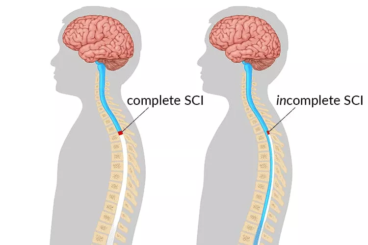 不完整和完整的脊髓損傷有什么區別 不完整和完整的脊髓損傷有什么區別