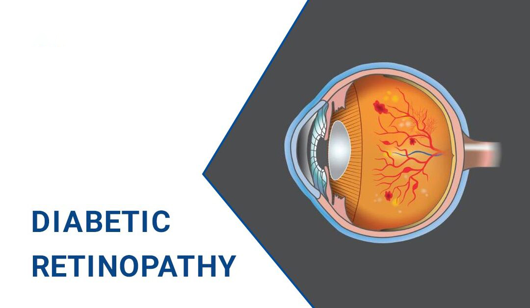 糖尿病視網(wǎng)膜病變–原因、階段和治療 糖尿病視網(wǎng)膜病變–原因、階段和治療