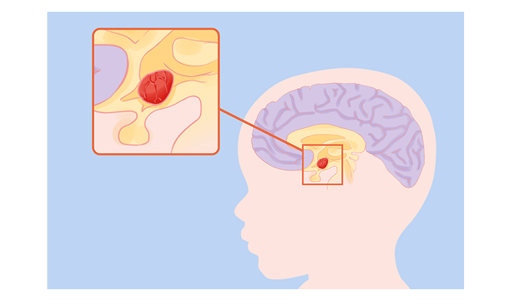 干細胞治療腦癱的成功率是多少？