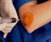 皮內給藥 皮內給藥