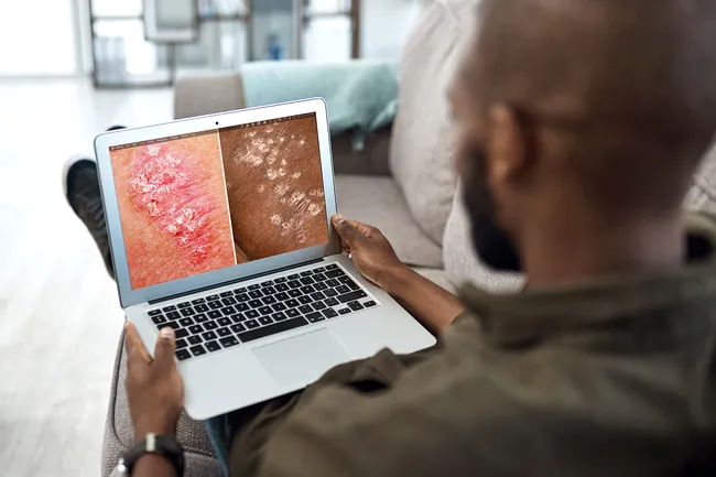 銀屑病的癥狀、類(lèi)型和原因 銀屑病的癥狀、類(lèi)型和原因