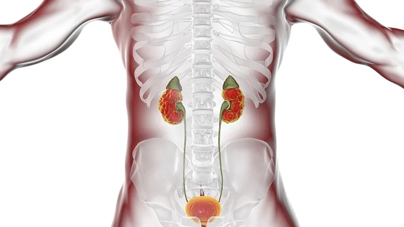 間充質(zhì)干細胞治療狼瘡性腎炎的臨床研究進展 間充質(zhì)干細胞治療狼瘡性腎炎的臨床研究進展