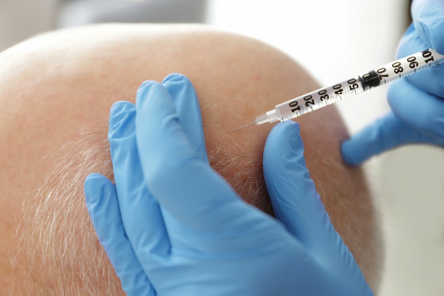 頭發(fā)修復(fù)過(guò)程是怎樣的? | 干細(xì)胞治療脫發(fā) 頭發(fā)修復(fù)過(guò)程是怎樣的? | 干細(xì)胞治療脫發(fā)