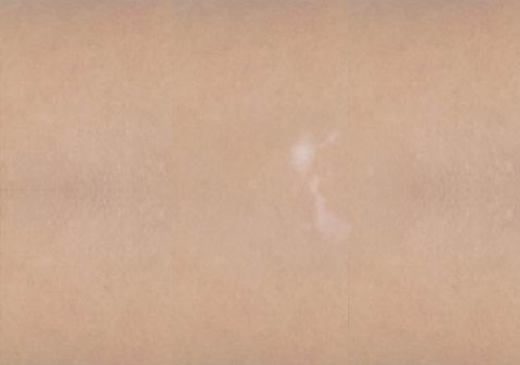 白癜風(fēng)白斑初期癥狀輕微小斑點(diǎn),無(wú)色素。 白癜風(fēng)白斑初期癥狀輕微小斑點(diǎn),無(wú)色素。