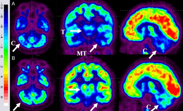 圖6：ASD患者在細(xì)胞治療前和細(xì)胞治療后6個(gè)月進(jìn)行的FDG-PET/CT大腦掃描的代表性圖像。