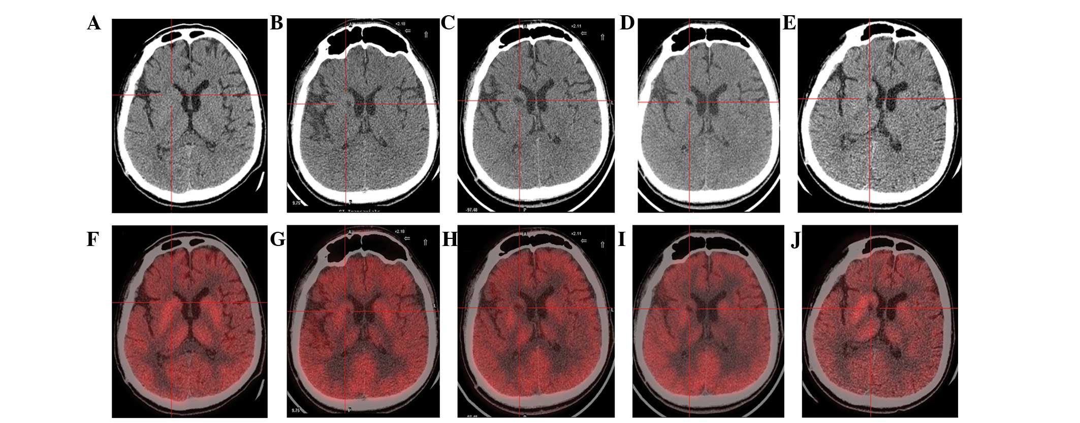 圖1:計(jì)算機(jī)斷層掃描 (CT) 和正電子發(fā)射斷層掃描 (PET) 掃描。 圖1:計(jì)算機(jī)斷層掃描 (CT) 和正電子發(fā)射斷層掃描 (PET) 掃描。