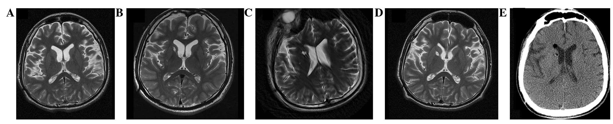 圖2:-T2加權(quán)磁共振成像 (MRI) 圖2:-T2加權(quán)磁共振成像 (MRI)