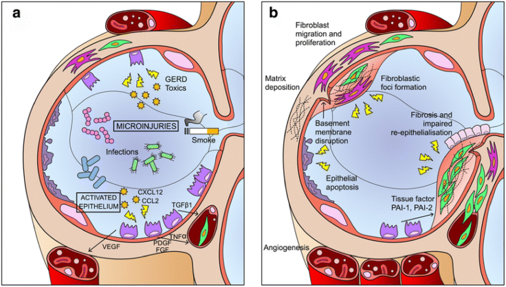 圖1:IPF發病機制示意圖 圖1:IPF發病機制示意圖