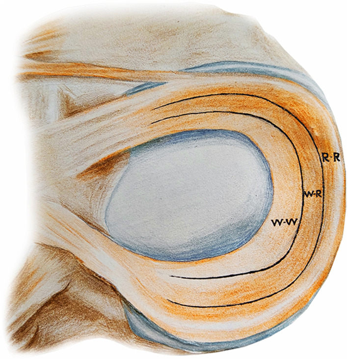 圖1：根據報告的血管分布，半月板的插圖展示了經典的三個區域