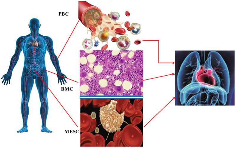 圖1:用于慢性缺血性心臟病移植的不同類型的干細胞 圖1:用于慢性缺血性心臟病移植的不同類型的干細胞