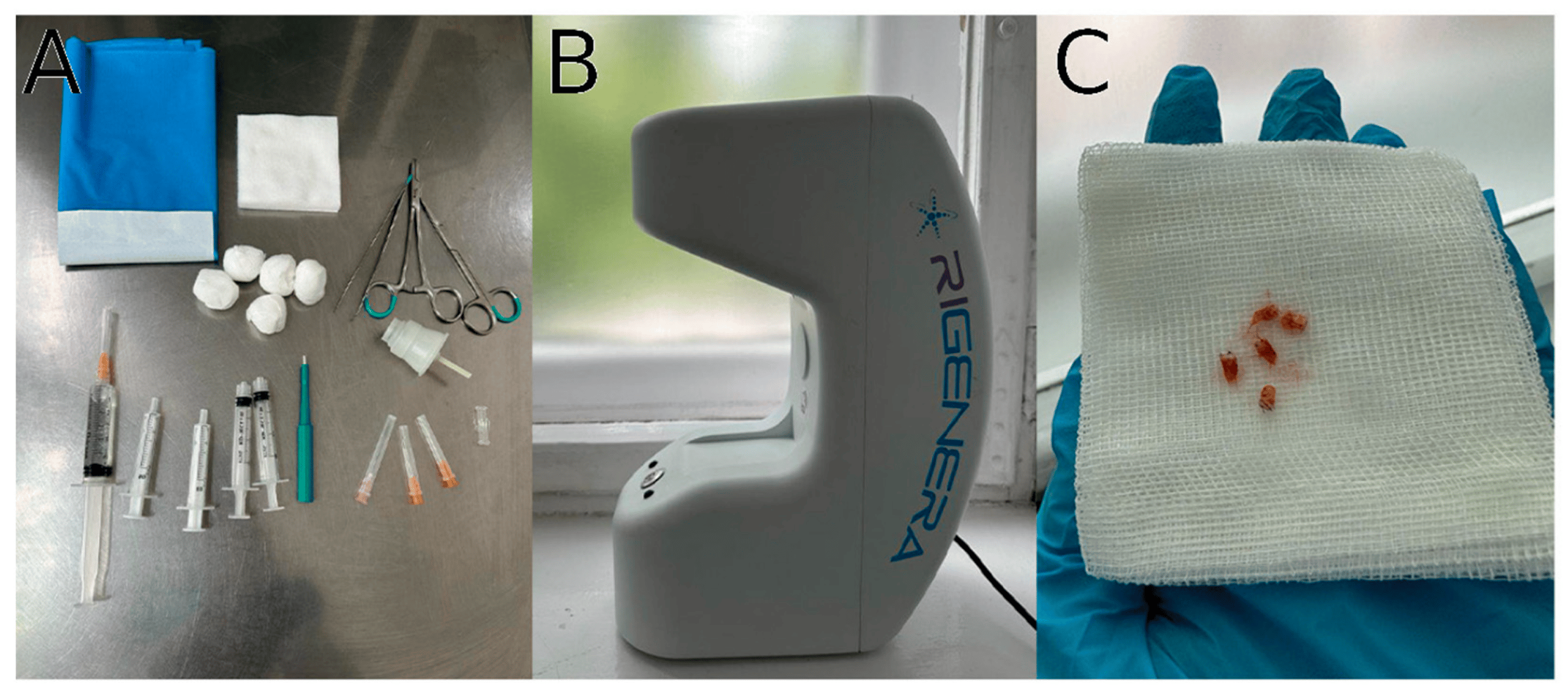 圖1:自體細胞微移植治療方案要素。 圖1:自體細胞微移植治療方案要素。
