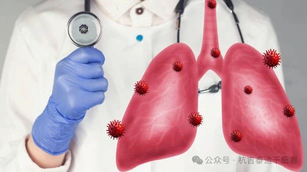 干細胞療法如何減緩肺部疾病的癥狀？