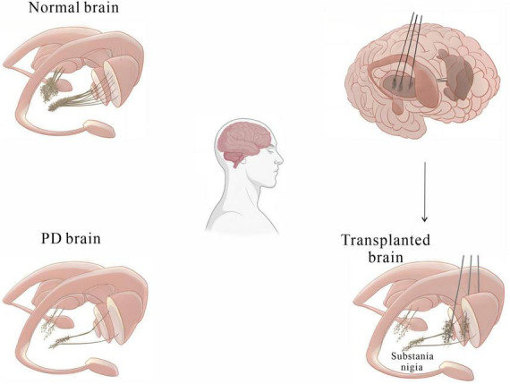圖2：基本圖顯示細胞移植療法如何緩解帕金森病患者的運動癥狀。