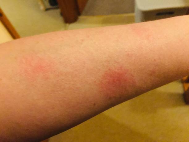 系統(tǒng)性紅斑狼瘡的最佳治療方法是什么? 系統(tǒng)性紅斑狼瘡的最佳治療方法是什么?