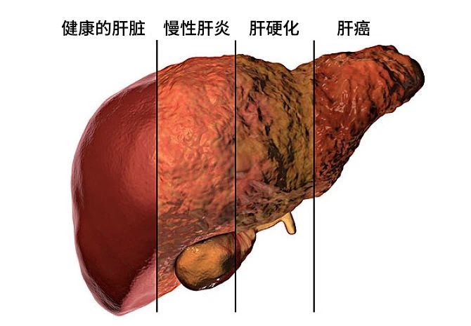 不同原因的肝損害發展主要分為三個階段:肝炎-肝硬化-肝癌。 不同原因的肝損害發展主要分為三個階段:肝炎-肝硬化-肝癌。