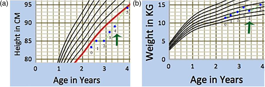 圖1:一名患有嚴(yán)重III型OI的男孩的生長(zhǎng)曲線圖。 圖1:一名患有嚴(yán)重III型OI的男孩的生長(zhǎng)曲線圖。