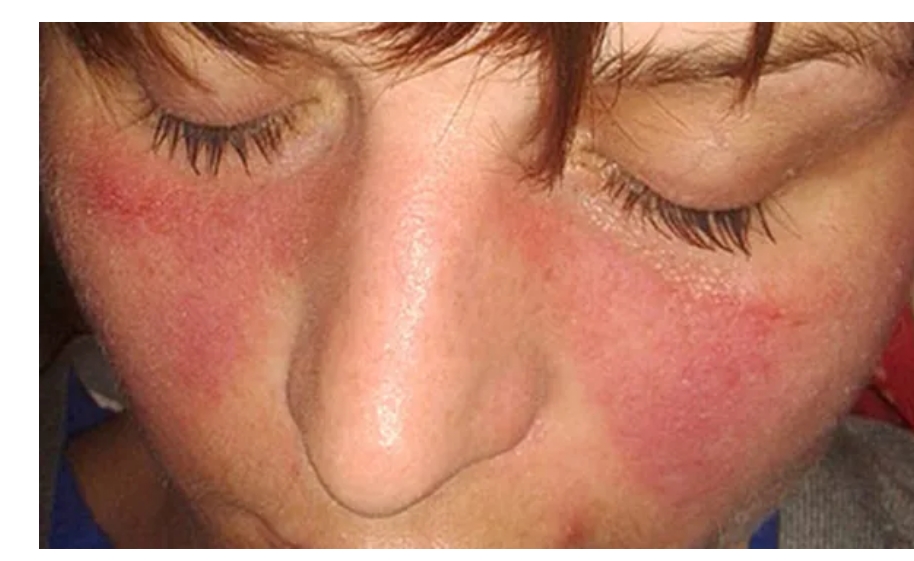 系統(tǒng)性紅斑狼瘡癥狀、病因和治療方法 系統(tǒng)性紅斑狼瘡癥狀、病因和治療方法