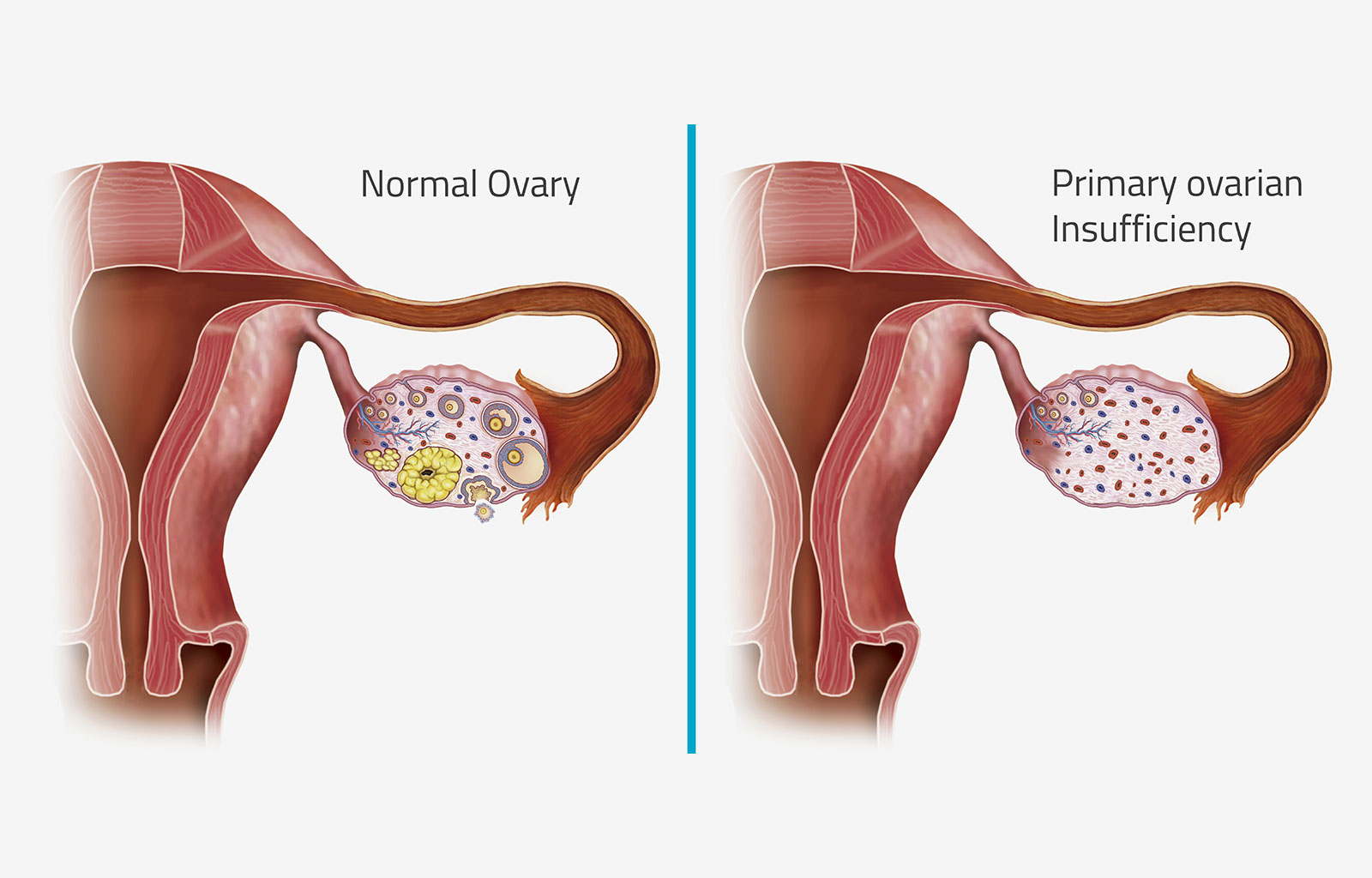 正常卵巢與患上卵巢早衰之后的卵巢對比 正常卵巢與患上卵巢早衰之后的卵巢對比