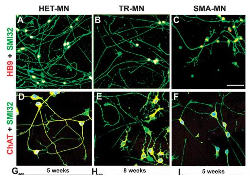 2012年干細(xì)胞治療脊髓性肌萎縮癥臨床案例 2012年干細(xì)胞治療脊髓性肌萎縮癥臨床案例