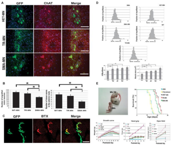 2012年干細(xì)胞治療脊髓性肌萎縮癥臨床案例 2012年干細(xì)胞治療脊髓性肌萎縮癥臨床案例
