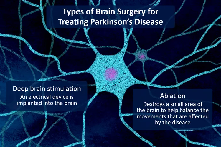 帕金森病的腦部手術(shù)：類型、恢復(fù)和風(fēng)險(xiǎn)