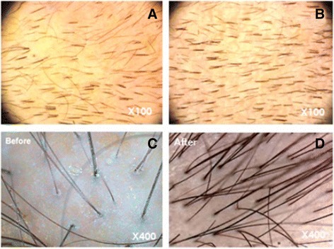 圖3:記錄脂肪干細(xì)胞療法后頭發(fā)數(shù)量增加的照片。移植前(ac)和移植后6個月(bd)頭皮的代表性圖像 圖3:記錄脂肪干細(xì)胞療法后頭發(fā)數(shù)量增加的照片。移植前(ac)和移植后6個月(bd)頭皮的代表性圖像