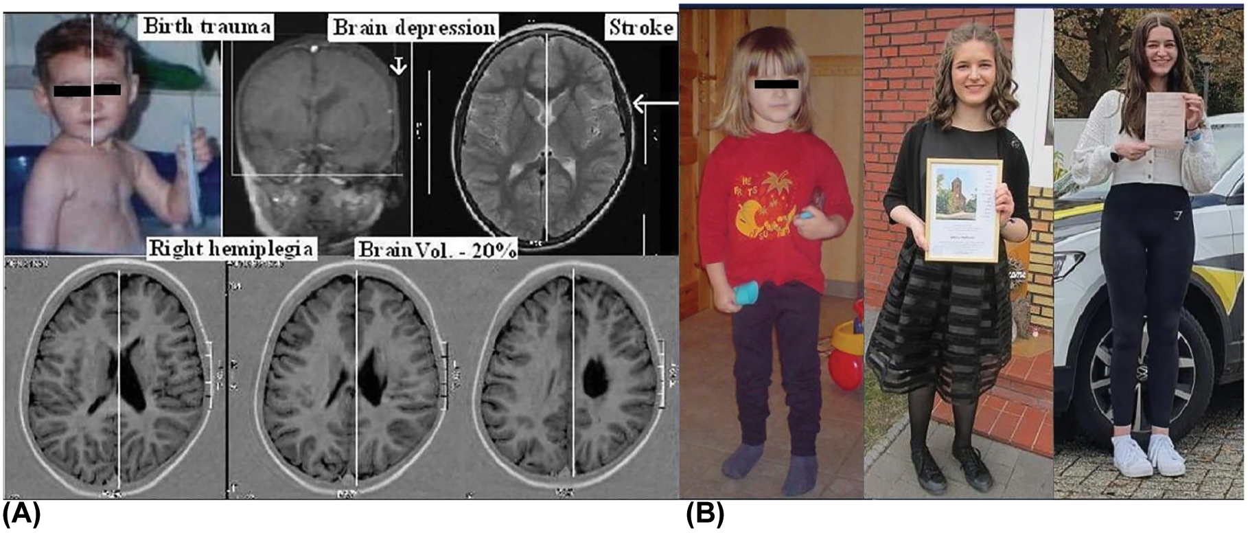 創傷是先天性腦癱的危險因素 創傷是先天性腦癱的危險因素