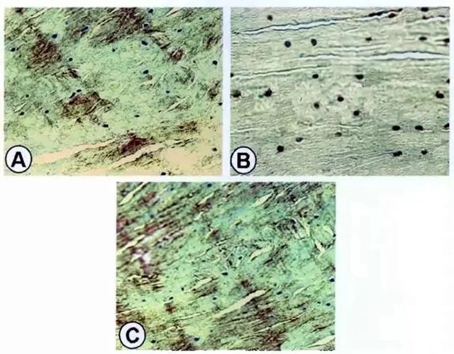 A為紅-紅區修復組織II型膠原的表達;B為紅-紅區修復組織S-100蛋白表達;C為紅-紅區修復組織I型膠原表達。 A為紅-紅區修復組織II型膠原的表達;B為紅-紅區修復組織S-100蛋白表達;C為紅-紅區修復組織I型膠原表達。