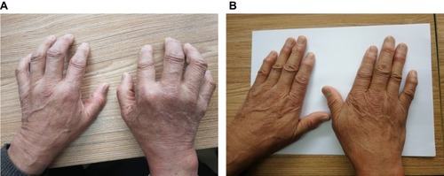 (圖1A)表現(xiàn)為雙手不能伸直。 (圖1B)治療3年后,停用抗風濕藥物5年,雙手伸展自如,關節(jié)周圍風濕結節(jié)逐漸變軟、消退。 (圖1A)表現(xiàn)為雙手不能伸直。
(圖1B)治療3年后,停用抗風濕藥物5年,雙手伸展自如,關節(jié)周圍風濕結節(jié)逐漸變軟、消退。