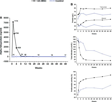 UC-MSC 輸血改善了一名急性慢性肝衰竭患者的血清 α-胎蛋白 (α-FP) 水平。