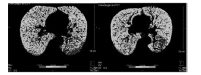 雙源CT肺實質分析軟件 雙源CT肺實質分析軟件