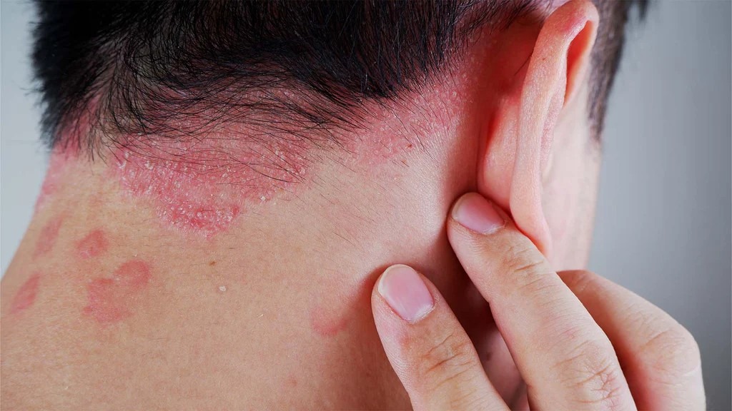 銀屑病如何治療?干細(xì)胞療法如何為銀屑病患者掃除障礙? 銀屑病如何治療?干細(xì)胞療法如何為銀屑病患者掃除障礙?