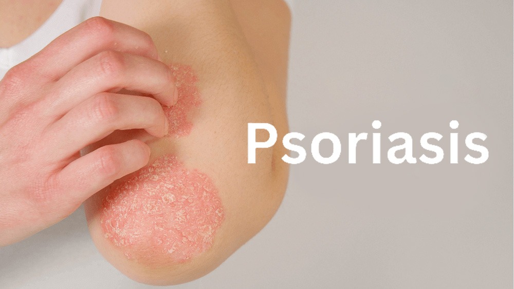 銀屑病治療新篇章:盤點2020-2024年干細胞治療銀屑病臨床研究進展 銀屑病治療新篇章:盤點2020-2024年干細胞治療銀屑病臨床研究進展