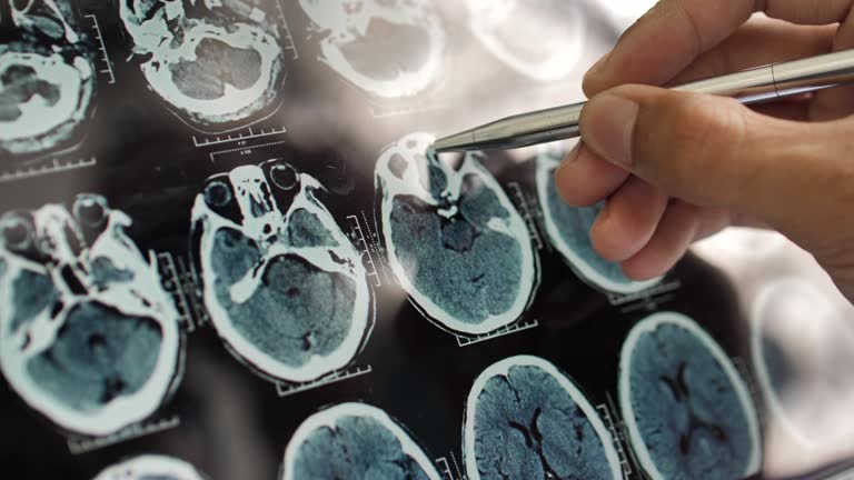 事關(guān)神經(jīng)退行性疾病,干細(xì)胞在治療神經(jīng)退行性疾病的療效、倫理、安全等問題的綜述 事關(guān)神經(jīng)退行性疾病,干細(xì)胞在治療神經(jīng)退行性疾病的療效、倫理、安全等問題的綜述