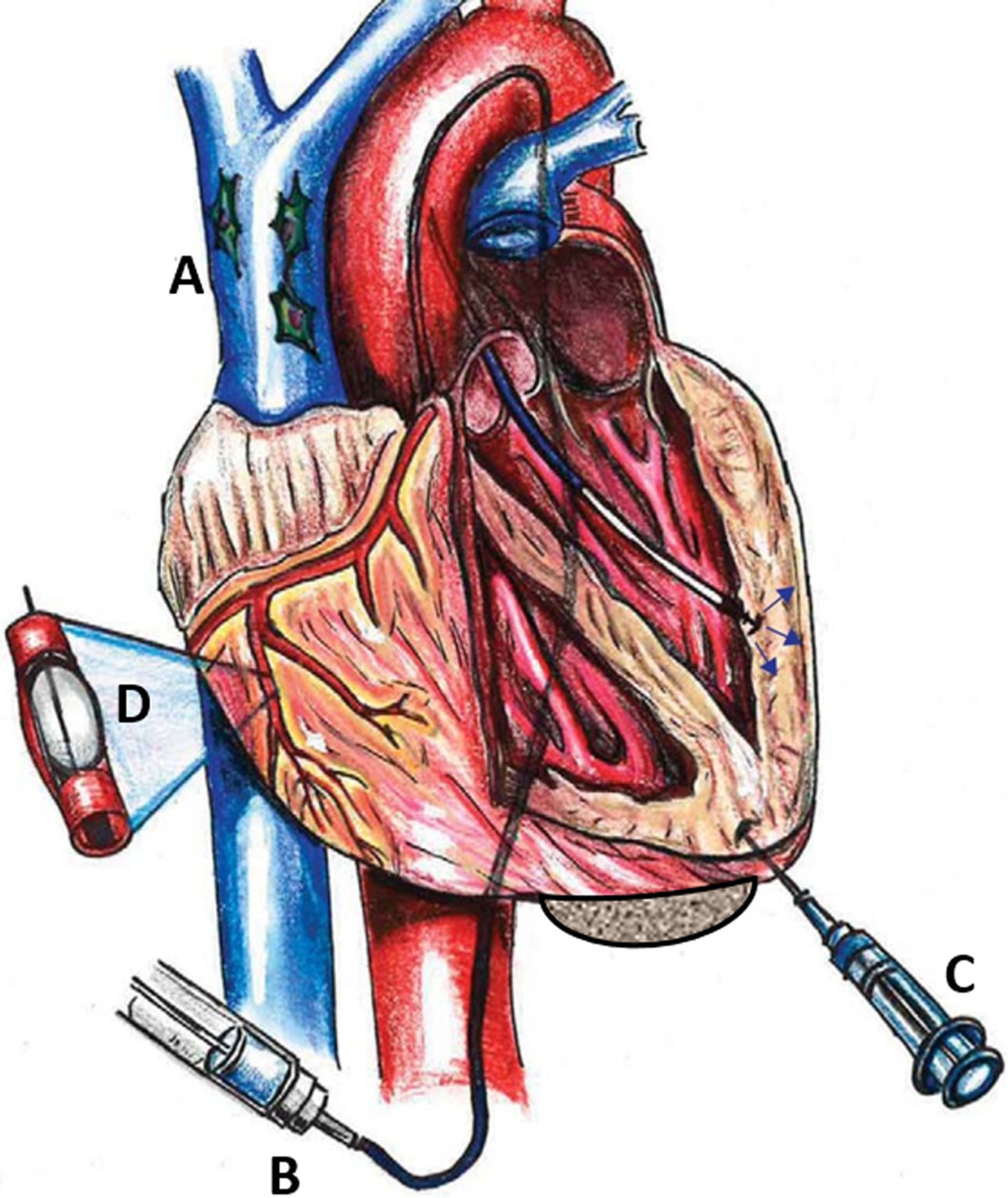 圖1：MSC通過系統 (Sys) 和局部 (Loc) 途徑進入心臟。