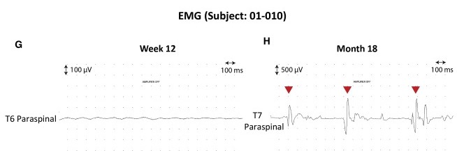 圖4:患者4腦運動控制評估(BMCA)和EMG評估 圖4:患者4腦運動控制評估(BMCA)和EMG評估