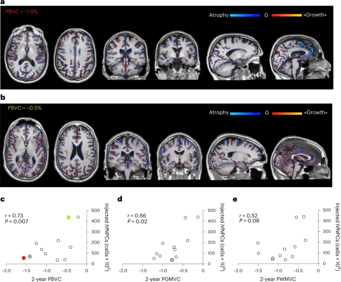 圖5：注射的神經干細胞數量與腦容量損失呈反比