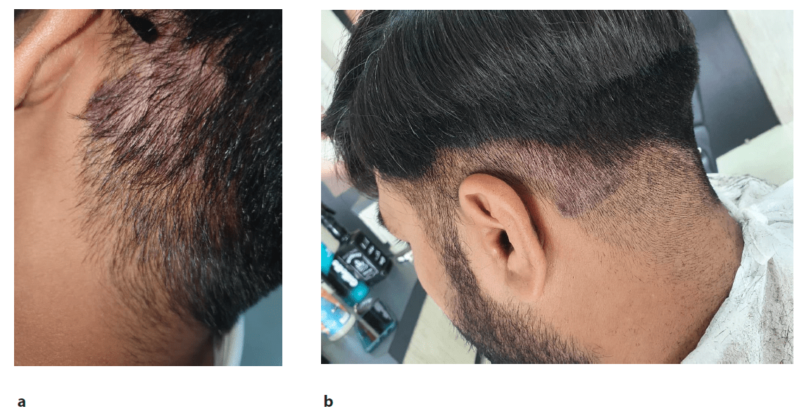 圖2:患者頸部枕部下方頭皮牛皮癬治療后圖像,治療后2周(a)和4周(b)隨訪時頭皮牛皮癬銀色鱗片和斑塊減少 圖2:患者頸部枕部下方頭皮牛皮癬治療后圖像,治療后2周(a)和4周(b)隨訪時頭皮牛皮癬銀色鱗片和斑塊減少