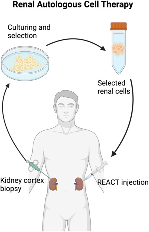 圖2:自體細胞治療腎臟疾病 圖2:自體細胞治療腎臟疾病
