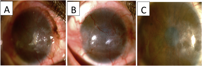 右眼 眼表鱗狀腫瘤照片。