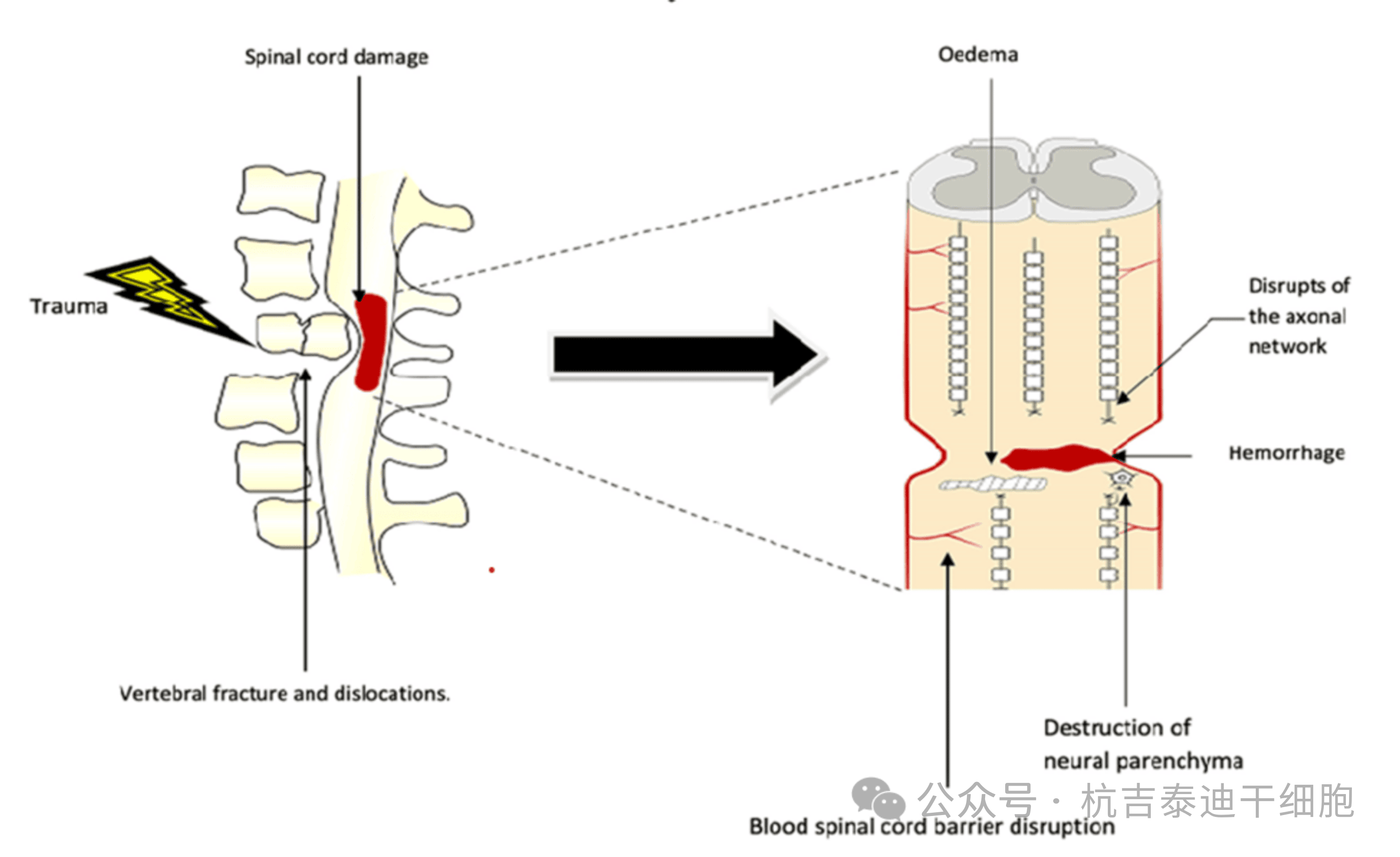 圖1：原發(fā)性病變，該圖顯示了創(chuàng)傷的直接影響，包括椎骨骨折、脫位和脊髓損傷導致軸突斷裂、水腫、出血和神經實質破壞