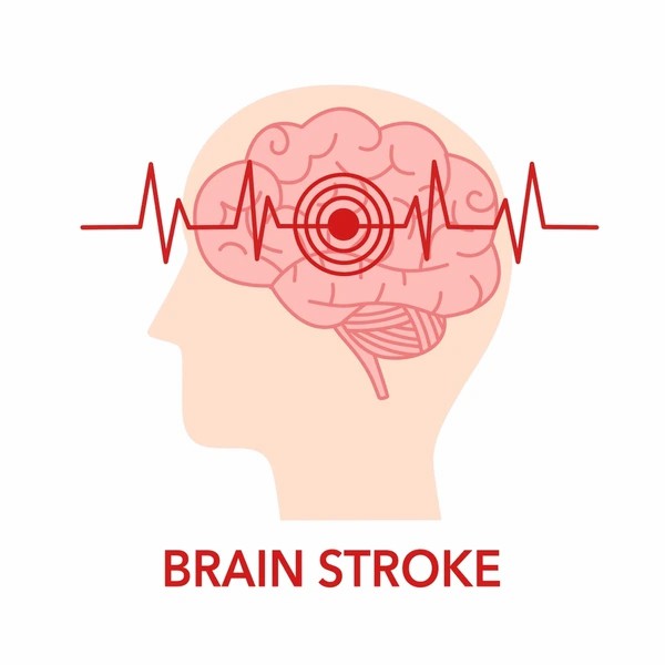 直擊腦卒中：神經(jīng)干細(xì)胞移植的治療方法有哪些？
