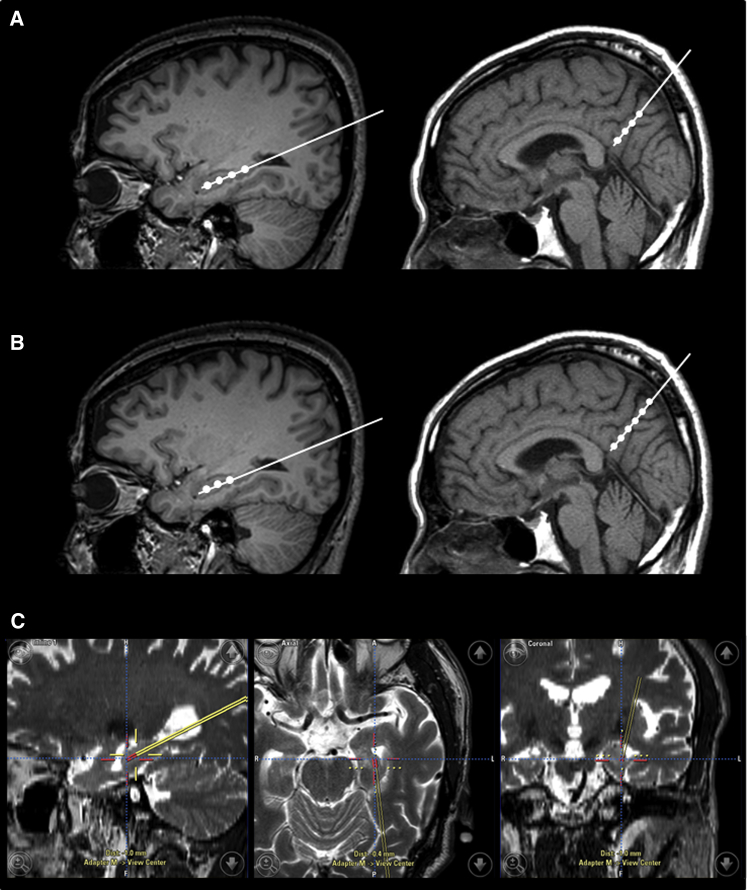 臍帶間充質干細胞的立體定向給藥 臍帶間充質干細胞的立體定向給藥